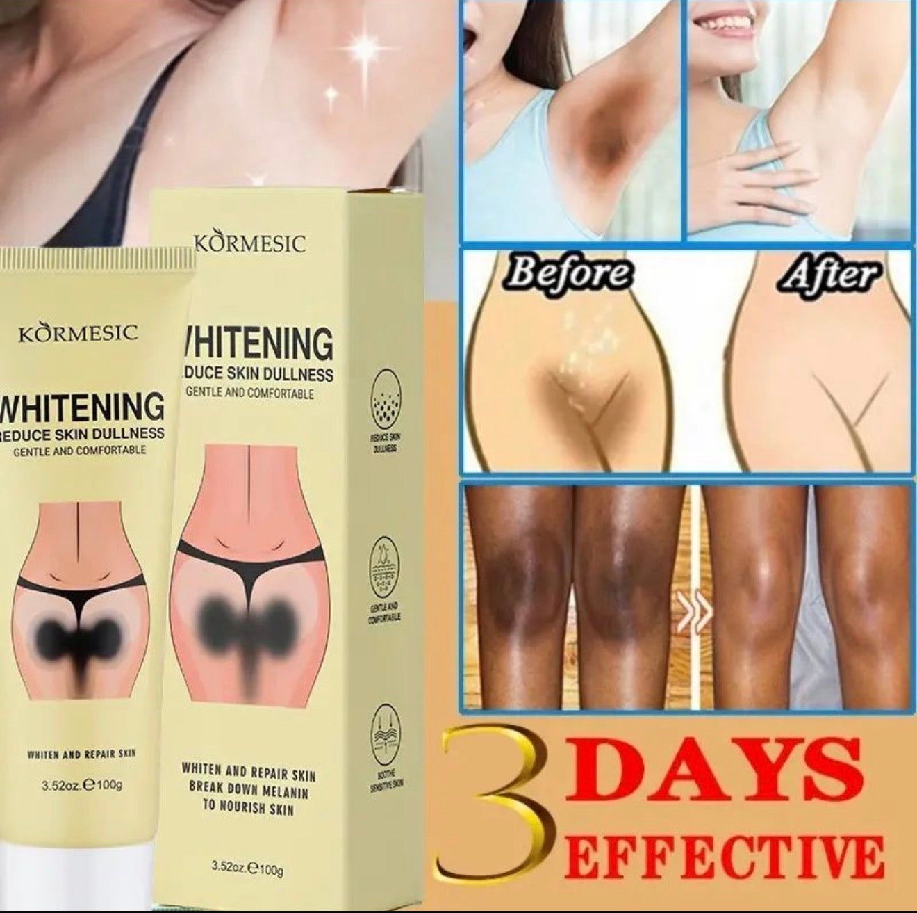 KORMESIC Intimate Whitening Cream – Dark Spots, Pigmentation & Dull Skin Removal | Visible Results in 10 Days