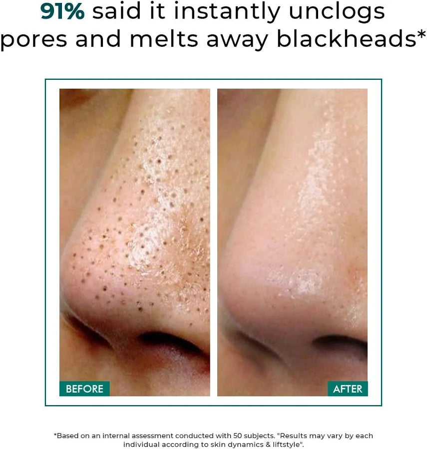 Professional Blackhead Remover Tool Kit – 5 in 1 Stainless Steel Pimple & Acne Extractor Set with Case